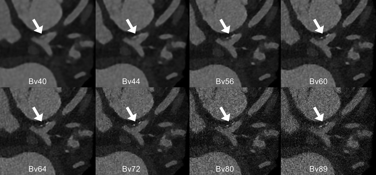 Ultra-High-Resolution Coronary CT Angiography With Photon-Counting Detector CT: Feasibility and Image Characterization