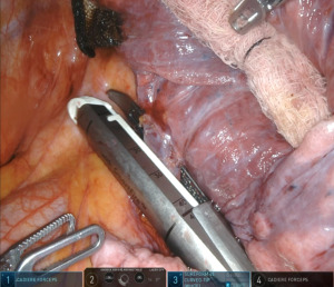 Complex Robotic Lung Resection