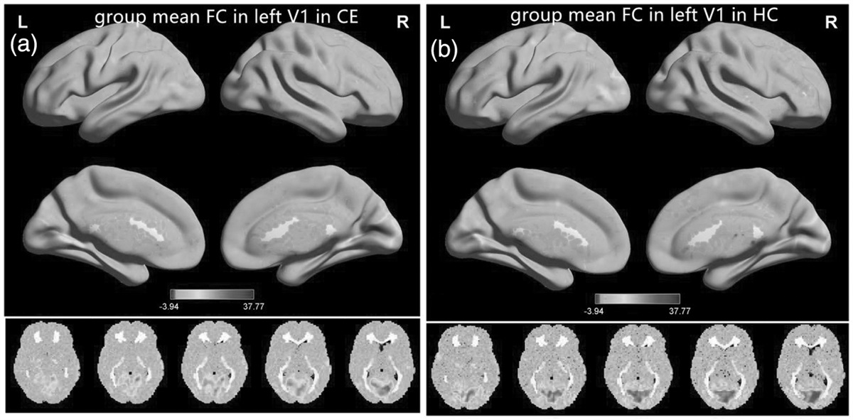 More than static: altered dynamic functional connectivity of primary visual cortex in the comitant exotropia patients