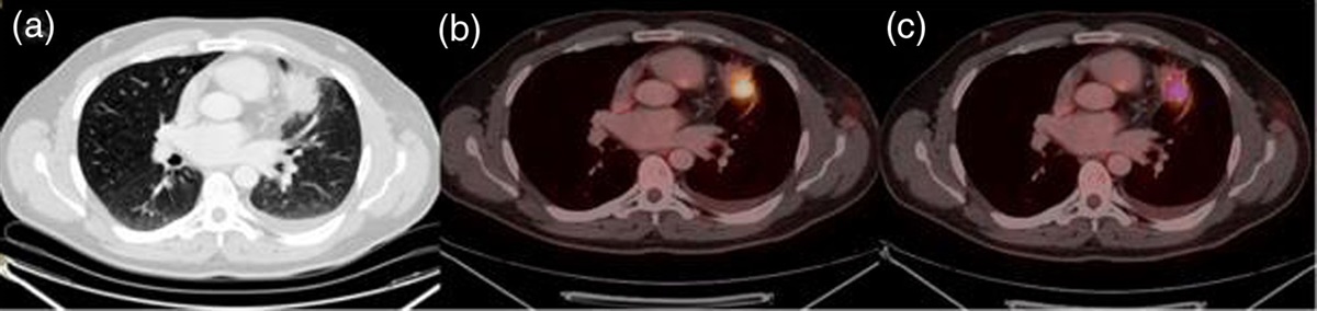 The prognostic relationship of 18F-FDG PET/CT metabolic and volumetric parameters in metastatic ALK + NSCLC