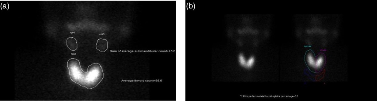 The utility of technetium-99m pertechnetate thyroid scintigraphy assessing thyroid/salivary ratio as an alternative to thyroid uptake percentage in evaluation of thyroid function, with establishing normal reference values of both parameters: single Egyptian center study