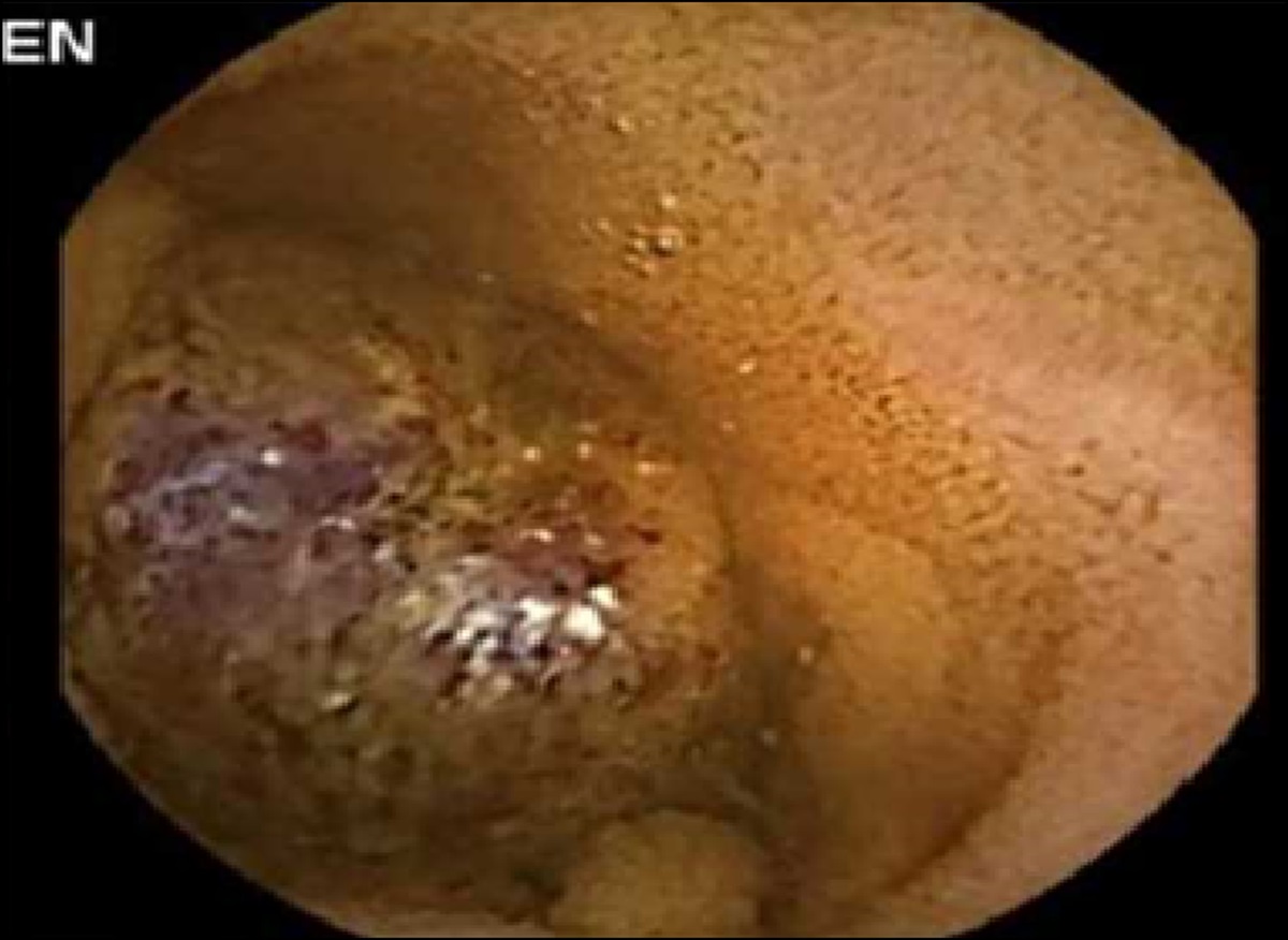 Endoscopic and Surgical Management of Blue Rubber Bleb Nevus Syndrome