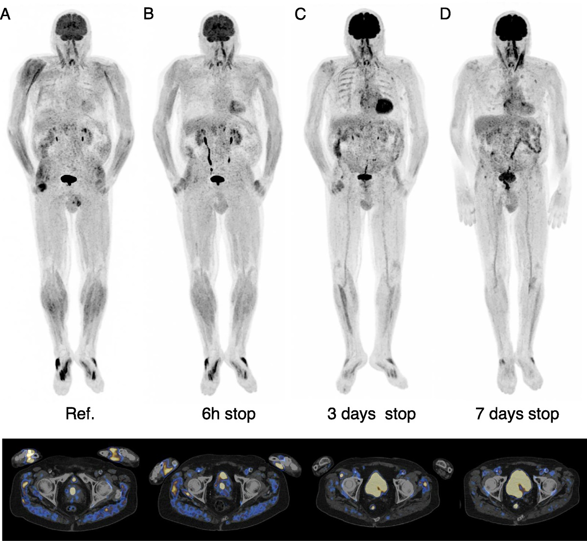 18F-FDG Muscular Uptake in Statin-Associated Symptoms Without Myositis: How Long to Stop Treatment for Image Quality Improvement?