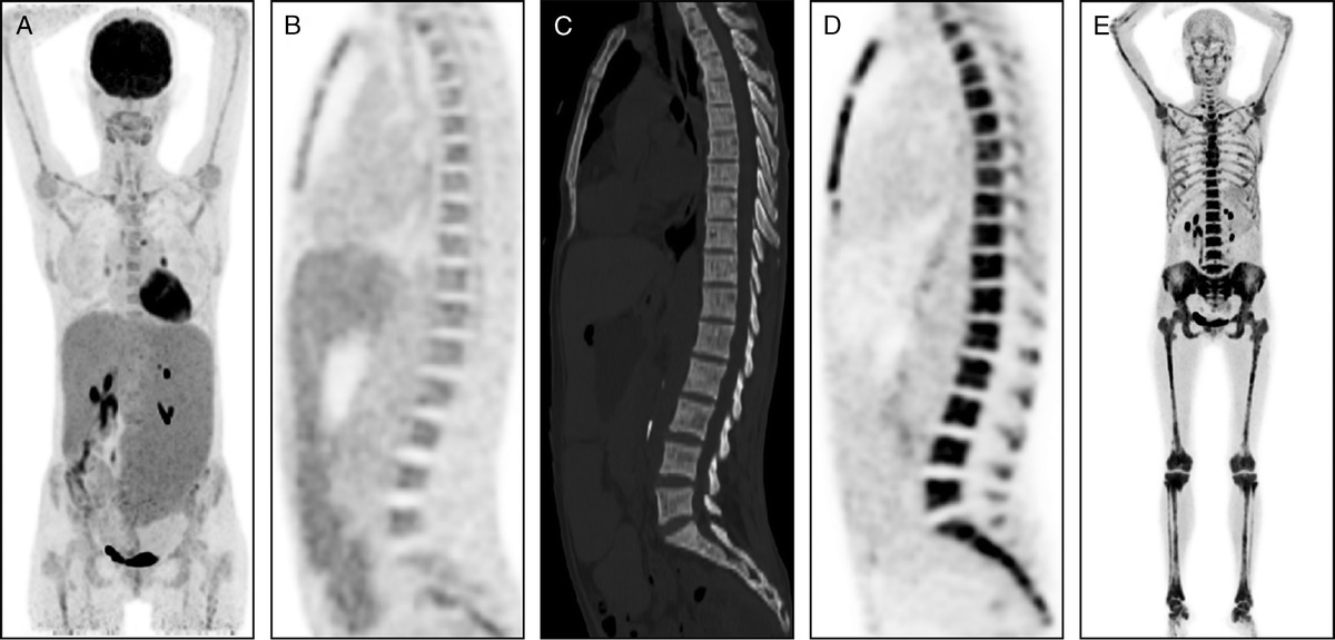 The Manifestation of a Patient With Myelofibrosis in 68Ga-DOTA-FAPI-04 PET/CT Mimicking “Super Bone Imaging”