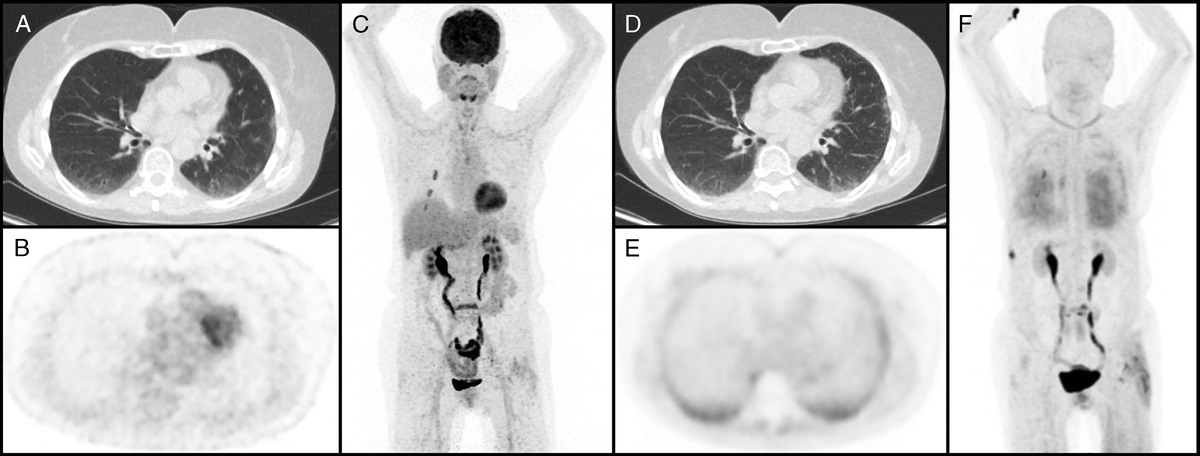 Enhancing Clinical Diagnosis for Patients With Persistent Pulmonary Abnormalities After COVID-19 Infection: The Potential Benefit of: 68: Ga-FAPI PET/CT