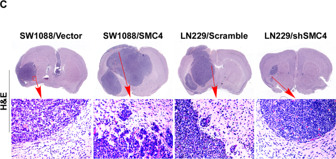 Correction: Overexpression of SMC4 activates TGFβ/Smad signaling and promotes aggressive phenotype in glioma cells