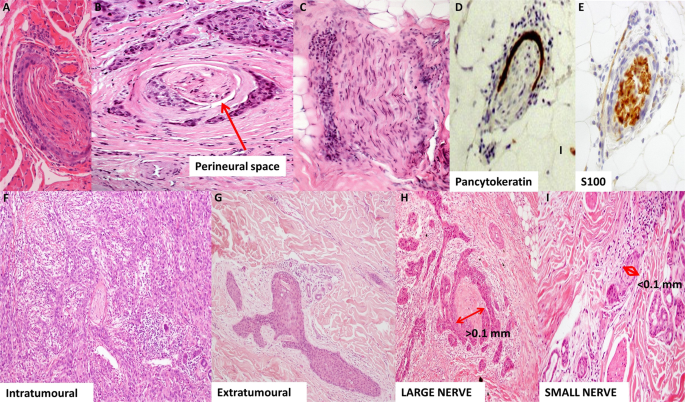 Perineural invasion and perineural spread in periocular squamous cell carcinoma