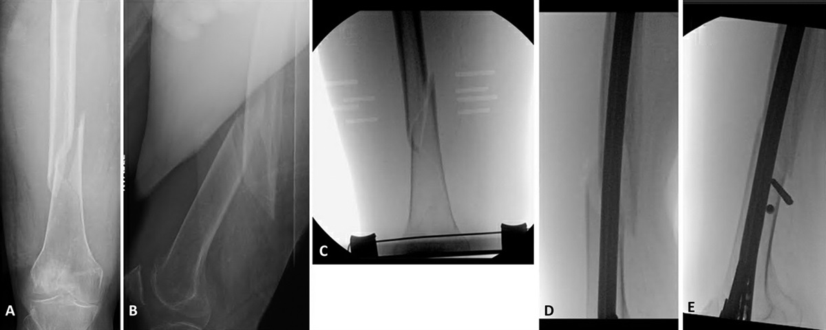 A Single Proximal Interlocking Bolt May Be Sufficient for Retrograde Nailing of Extra-articular Femur Fractures