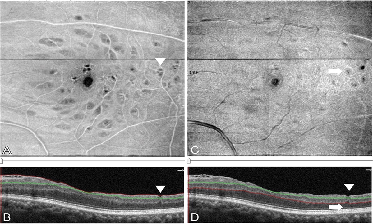 INTERNAL LIMITING MEMBRANE PEELING DISTORTS THE RETINAL LAYERS AND INDUCES SCOTOMA FORMATION IN THE PERIFOVEAL TEMPORAL MACULA
