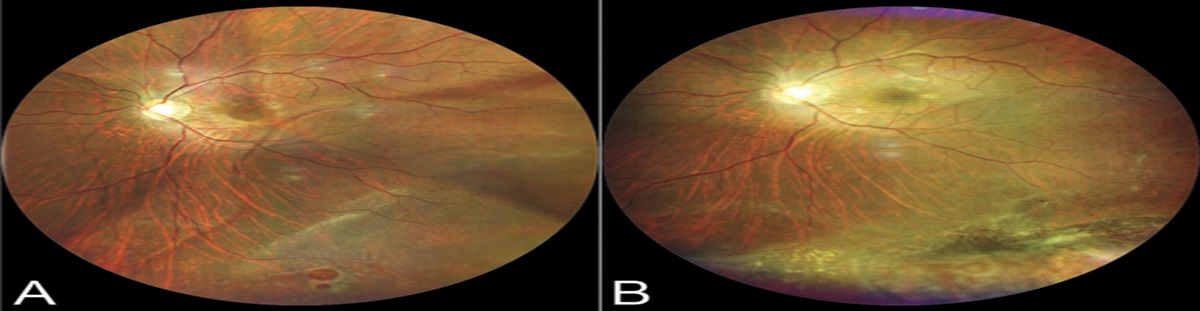 INTRAOPERATIVE OPTICAL COHERENCE TOMOGRAPHY FOR REAL-TIME VISUALIZATION OF THE POSITIONAL RELATIONSHIP BETWEEN BUCKLING MATERIAL AND RETINAL BREAKS DURING SCLERAL BUCKLING FOR RHEGMATOGENOUS RETINAL DETACHMENT