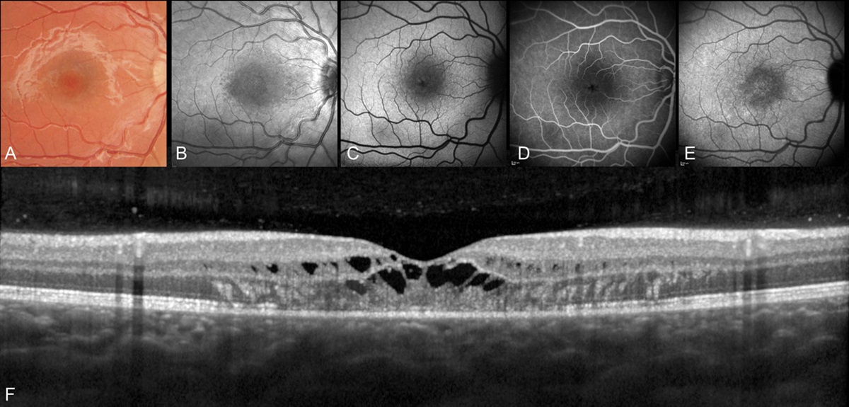 Mystery of changing choroidal thickness