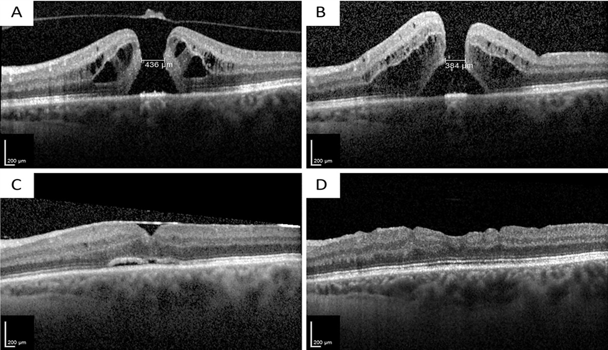 TREATMENT OF PERSISTENT MACULAR HOLES WITH HEAVY SILICONE OIL