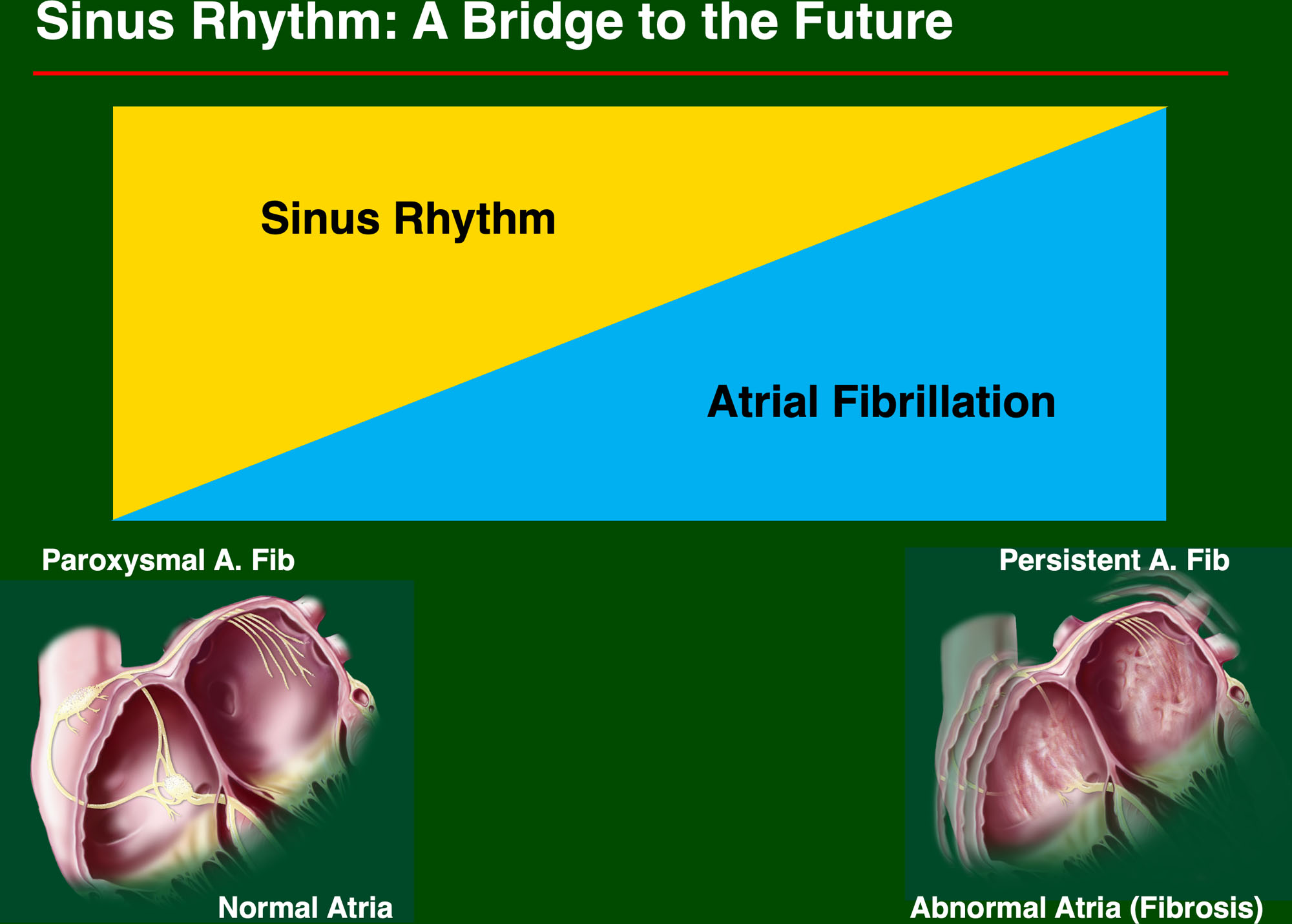 Rate Versus Rhythm Control for Atrial Fibrillation: Has the Debate Been Settled?