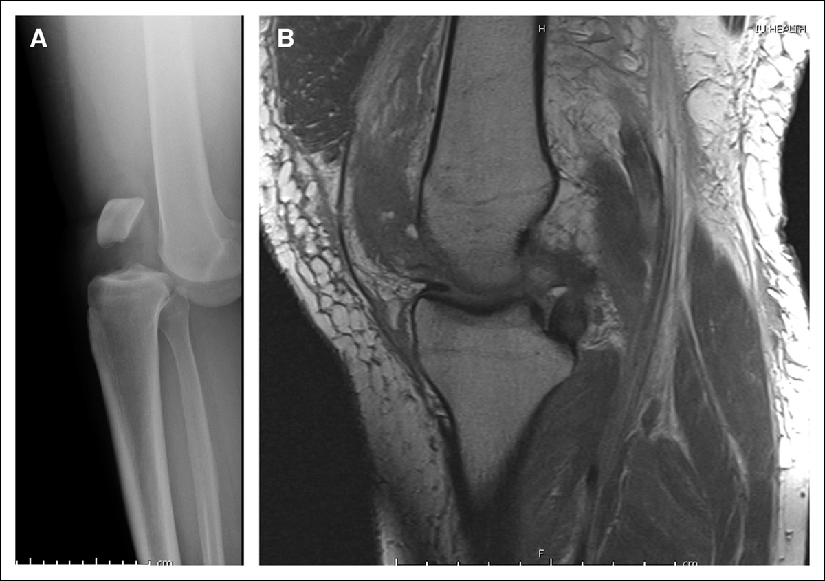 Multiligamentous Knee Injuries: Acute Management, Associated Injuries, and Anticipated Return to Activity