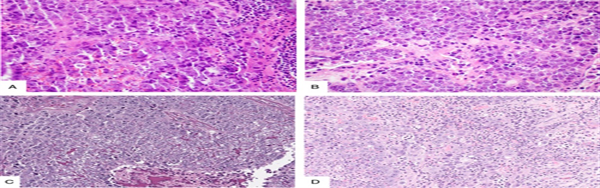NUTM1-rearranged Carcinoma of the Thyroid: A Distinct Subset of NUT Carcinoma Characterized by Frequent: NSD3: -: NUTM1: Fusions