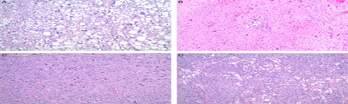 Pleomorphic Liposarcoma: A Series of 120 Cases With Emphasis on Morphologic Variants
