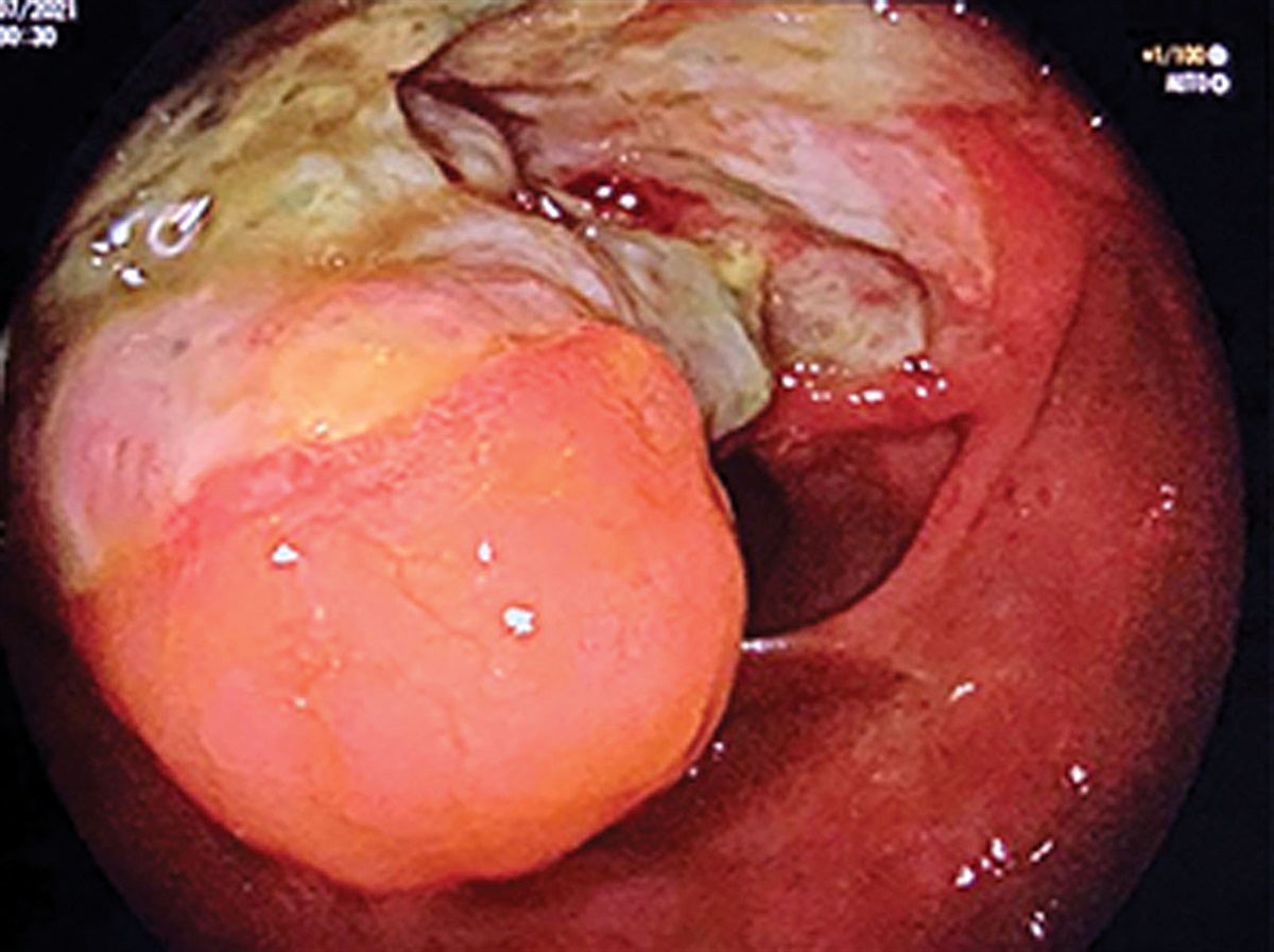 EBV-Positive Mucocutaneous Ulcer in Pediatric Crohn Disease—The Importance of Pathology