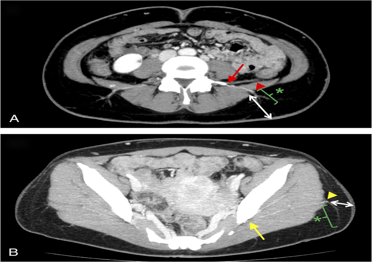 Comparison of Lumbar Artery and Superior Gluteal Artery Perforator Flaps for Breast Reconstruction: Multislice CT-Based Anatomical Study