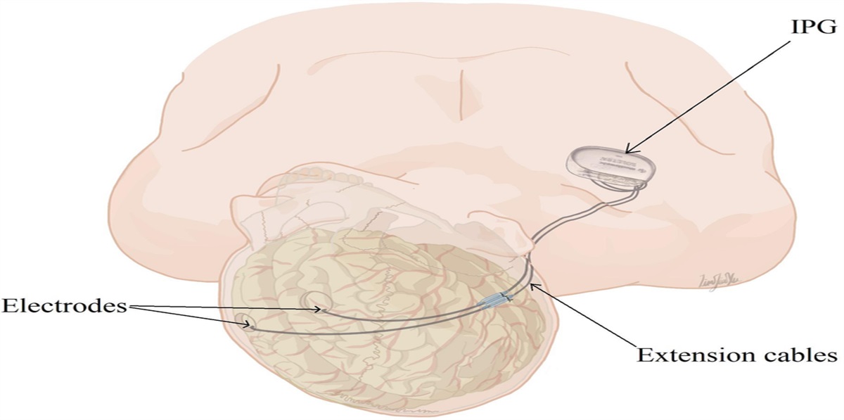 Saving the Exposed Deep Brain Stimulation Implant: A Comprehensive Review of Implant Extrusion and Reconstructive Options