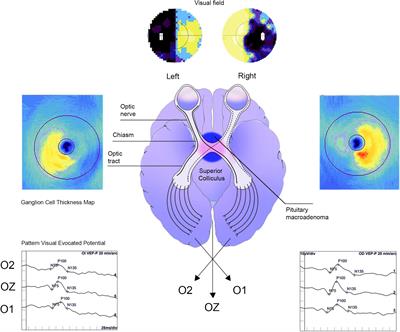 Bi-nasal sectors of ganglion cells complex and visual evoked potential amplitudes as biomarkers in pituitary macroadenoma management