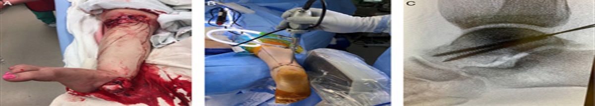 Arthroscopic Reduction and Internal Fixation of Talus Fractures: An All-inside Soft-tissue Preserving Technique