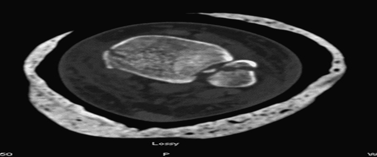 A Novel Operative Approach to the Treatment of Posterior Malleolus Fractures