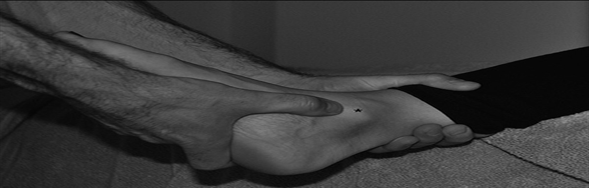 Treatment of the Deltoid and Syndesmotic Ligaments in Chronic Ankle Instability