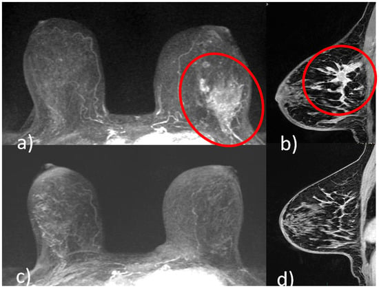 Cancers, Vol. 14, Pages 5786: Staging Breast Cancer with MRI, the T. A Key Role in the Neoadjuvant Setting