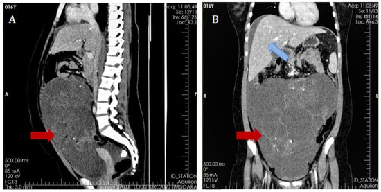 Medicina, Vol. 58, Pages 1715: Insights on Lipomatosis after Platinum-Based Chemotherapy Use in Pediatric Oncology: A Case Report