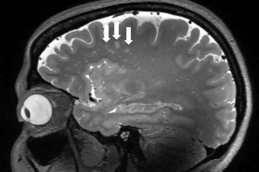 MRI Study Reveals Never Before Seen Brain Changes in Migraine