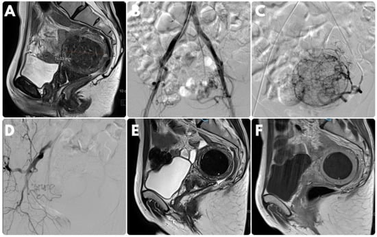 Medicina, Vol. 58, Pages 1732: Unilateral Uterine Artery Embolization as a Treatment for Patients with Symptomatic Fibroids—Experience in a Case Series
