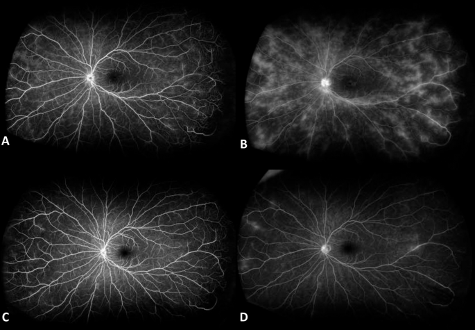 Six-month outcomes of infliximab and tocilizumab therapy in non-infectious retinal vasculitis