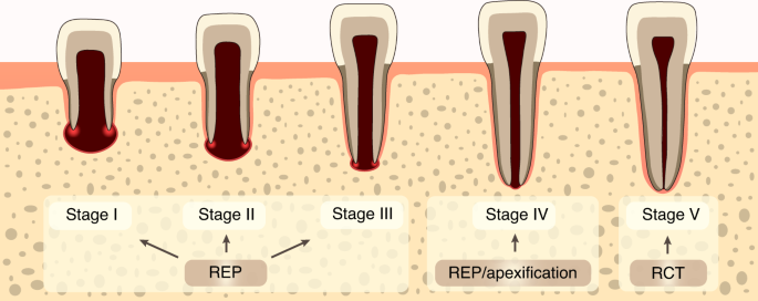 Expert consensus on regenerative endodontic procedures