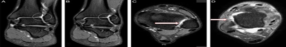 The “Flying V”: A Novel Construct to Address Concurrent Lateral Ankle and Syndesmotic Instability