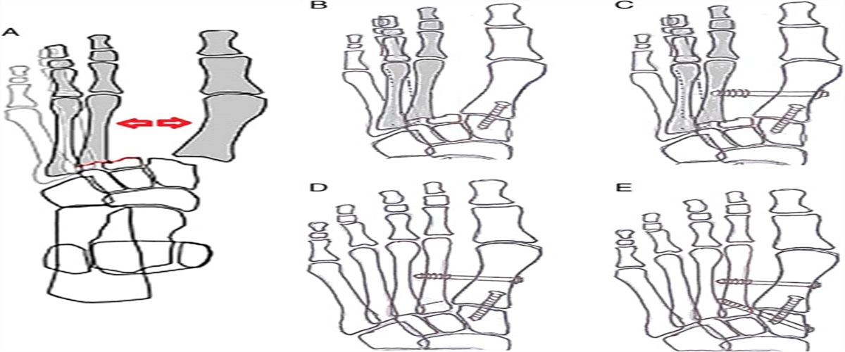 Intermetatarsal Reduction Screw: A Novel Closed Reduction Technique for Isolated Lateral and Divergent Lisfranc Injuries of the Foot