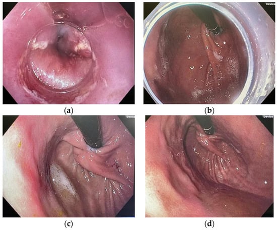 JCM, Vol. 11, Pages 7141: Utilization of Antireflux Mucosectomy and Resection and Plication: A Novel Approach for the Management of Recurrent Gastroesophageal Reflux Disease after Prior Nissen Fundoplication or Transoral Incisionless Fundoplication