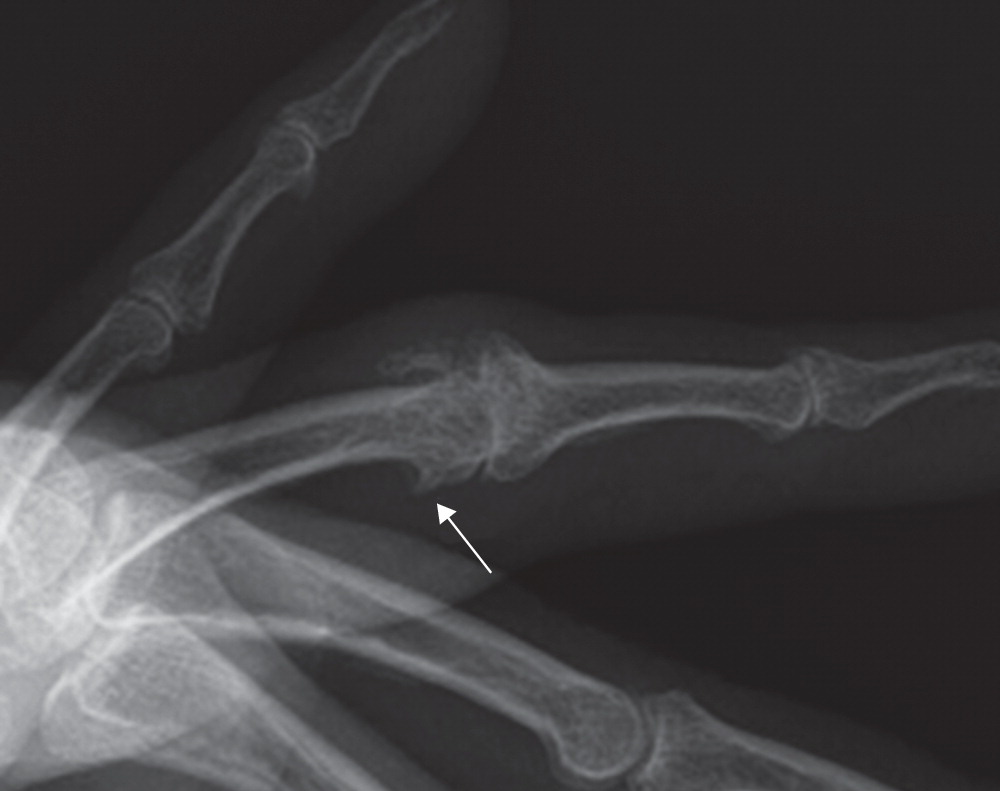 Surgical approaches for proximal interphalangeal joint arthroplasty