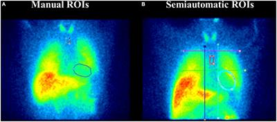 Manual and semi-automated approaches to MIBG myocardial scintigraphy in patients with Parkinson’s disease