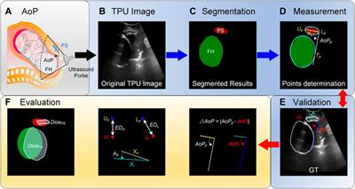 A framework for computing angle of progression from transperineal ultrasound images for evaluating fetal head descent using a novel double branch network