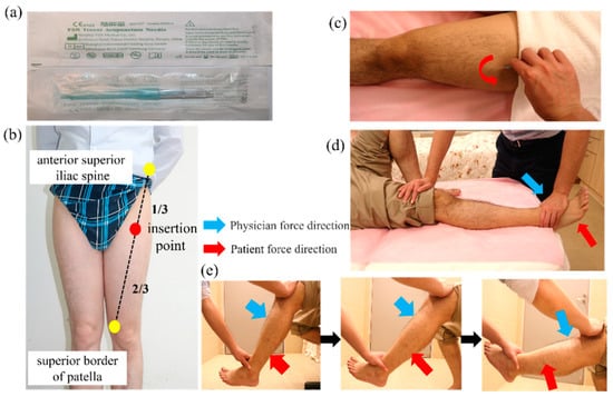JCM, Vol. 11, Pages 7184: Efficacy of Fu’s Subcutaneous Needling in Treating Soft Tissue Pain of Knee Osteoarthritis: A Randomized Clinical Trial