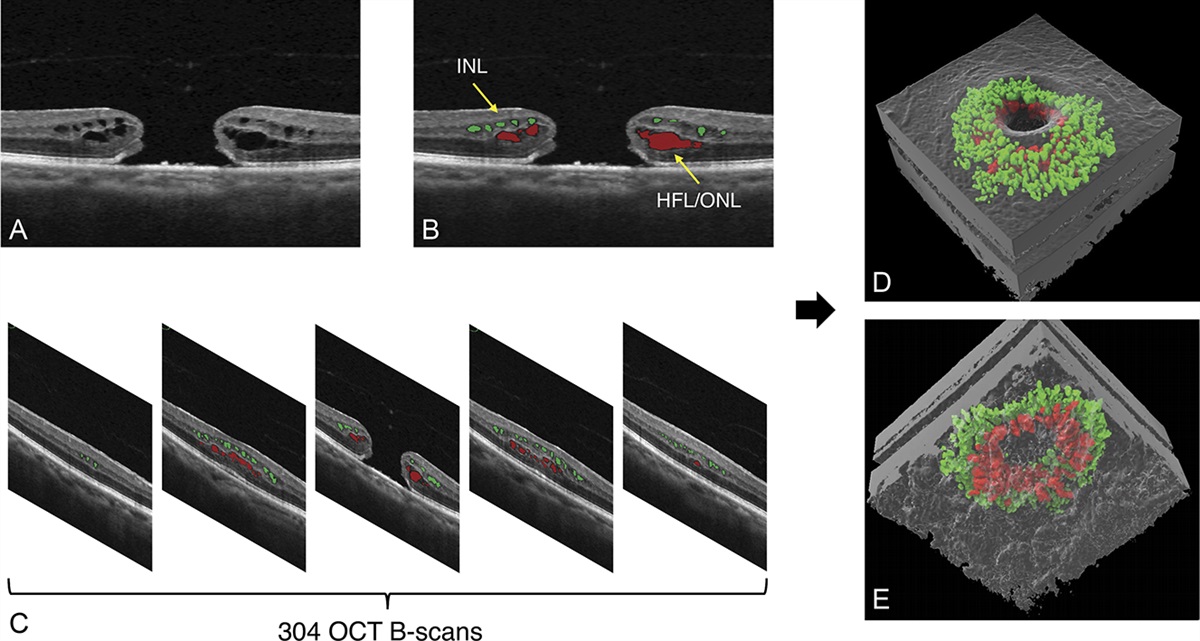 THREE-DIMENSIONAL QUANTIFICATION OF INTRARETINAL CYSTOID SPACES ASSOCIATED WITH FULL-THICKNESS MACULAR HOLE