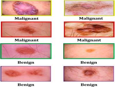 Early and accurate detection of melanoma skin cancer using hybrid level set approach