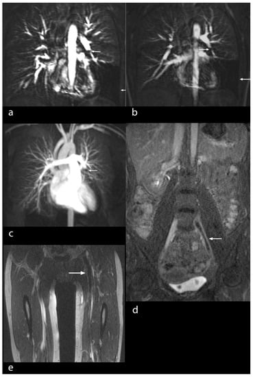 Diseases, Vol. 10, Pages 122: Gadofosveset-Trinatrium-Enhanced MR Angiography and MR Venography in the Diagnosis of Venous Thromboembolic Disease: A Single-Center Cohort Study