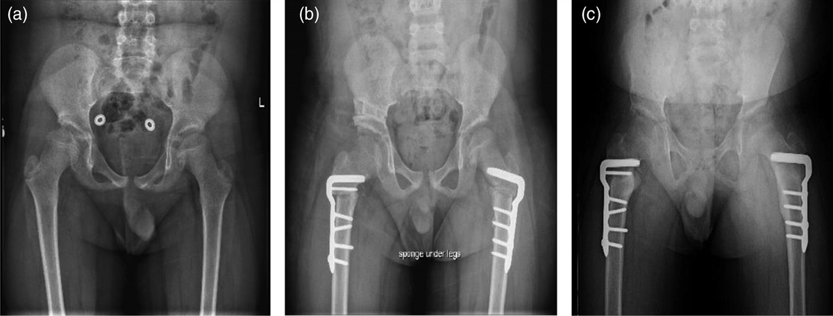 Blade plate versus locking plate fixation of proximal femoral varus osteotomy in children with cerebral palsy