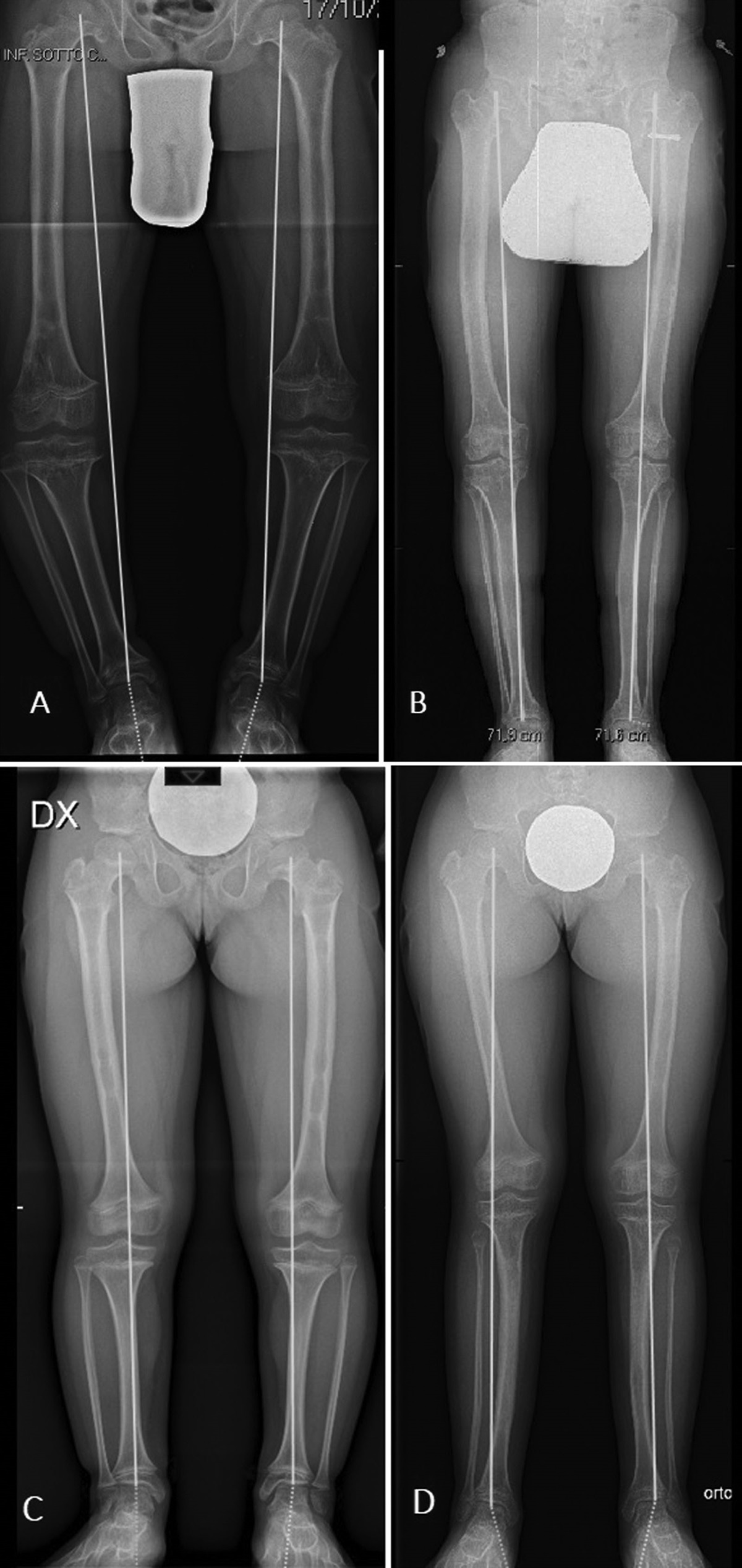 Role of proximal tibiofibular fixation in leg lengthening with the Ilizarov method in the achondroplastic patient