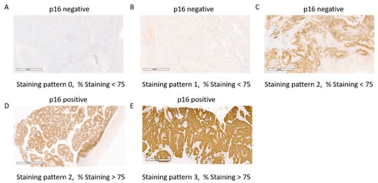 Cancers, Vol. 14, Pages 6024: Prognostic Significance of p16 and Its Relationship with Human Papillomavirus Status in Patients with Penile Squamous Cell Carcinoma: Results of 5 Years Follow-Up