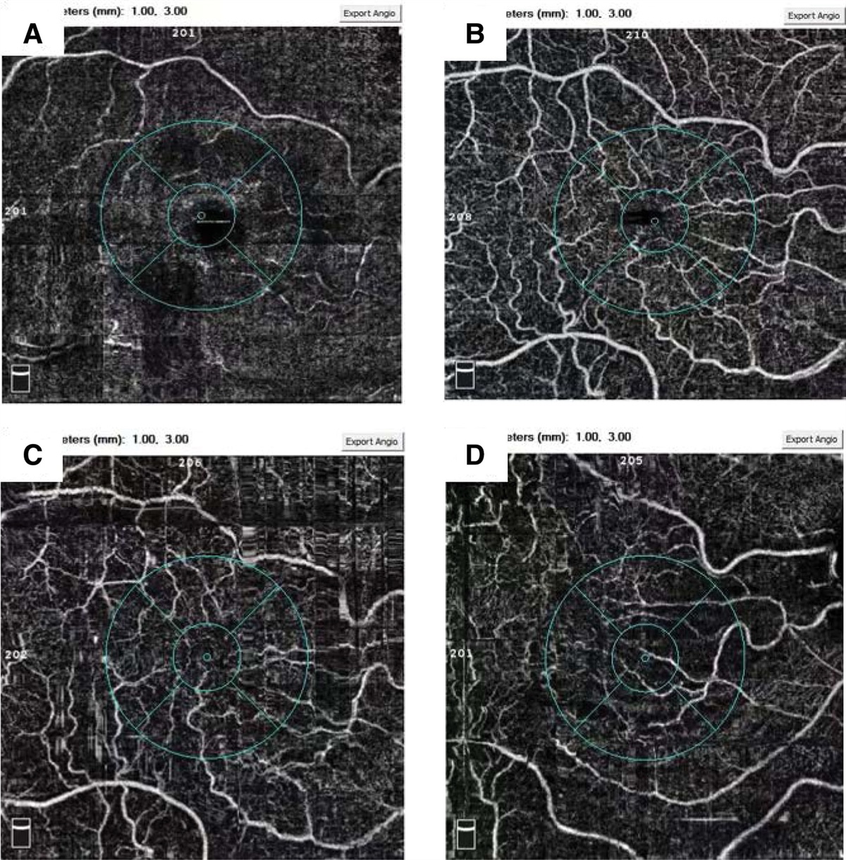 Functional features in patients with idiopathic macular hole treatment via OCT angiography