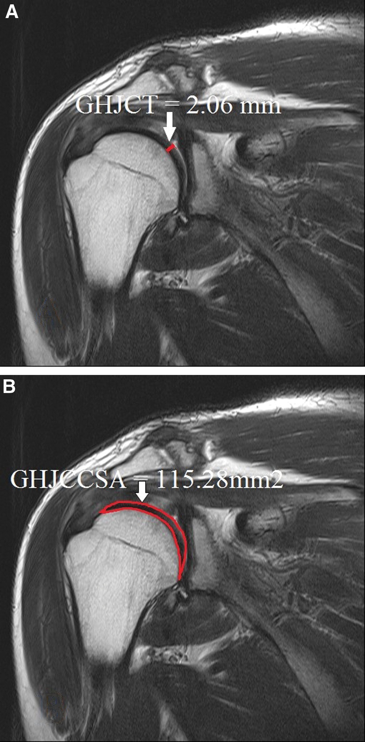 The value of the glenohumeral joint cross-sectional area as a morphological parameter of glenohumeral osteoarthritis
