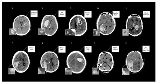Tomography, Vol. 8, Pages 2893-2901: Diagnostic Accuracy and Reliability of Noncontrast Computed Tomography Markers for Acute Hematoma Expansion among Radiologists