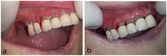 Dentistry Journal, Vol. 10, Pages 232: Oral Side Effects in Patients with Metastatic Renal Cell Carcinoma Receiving the Antiangiogenic Agent Pazopanib—Report of Three Cases